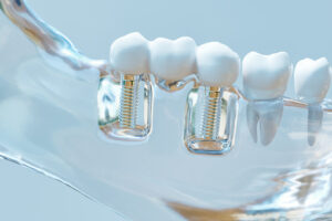 3D rendering of dental implants illustrated by Dens Dental Studio in Chicago, IL.