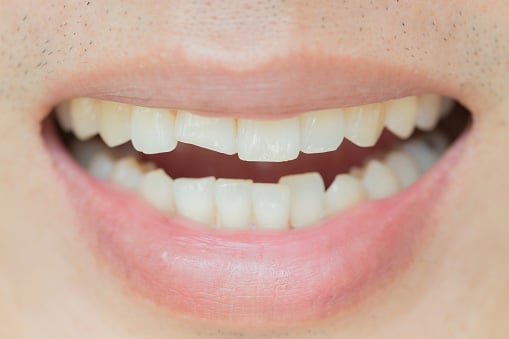 Close up of tooth with chip, needing repair from Dens Dental Studio in Chicago, IL.