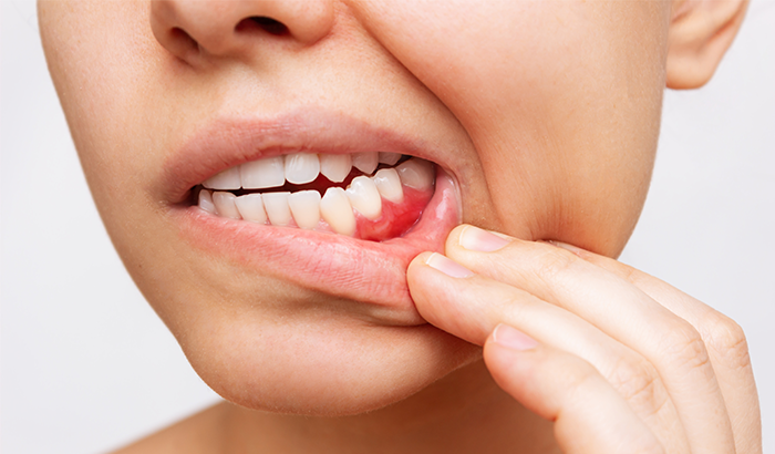 Close up of woman pulling down lower lip to reveal inflamed gums, needing dental care from Dens Dental Studio in Uptown Chicago, IL.